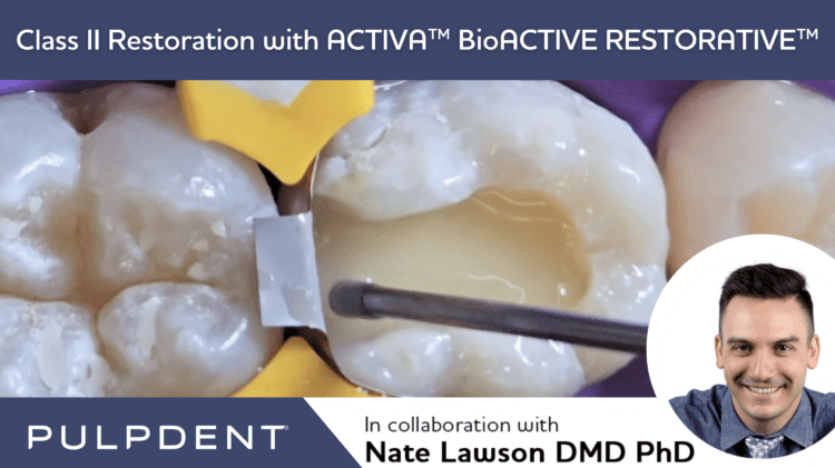 Lesen Sie mehr über den Artikel Klasse II Restauration mit ACTIVA™ BioACTIVE-RESTORATIVE™