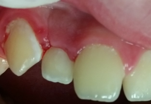 Lesen Sie mehr über den Artikel Direkt aus dem Operationssaal: Bulk-Füllung mit ACTIVA BioACTIVE-RESTORATIVE