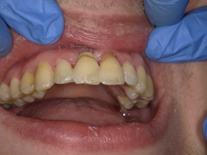 Lesen Sie mehr über den Artikel Heroische Zahnmedizin: Trauma, externe Resorption, Extraktion und Schienung der natürlichen Zahnkrone mit ACTIVA