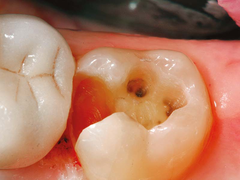 clinical-procedure-activa-baseliner-1