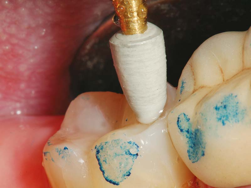 clinical-procedure-activa-baseliner-4