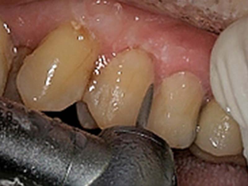 clinical-procedure-embrace-class-v-5