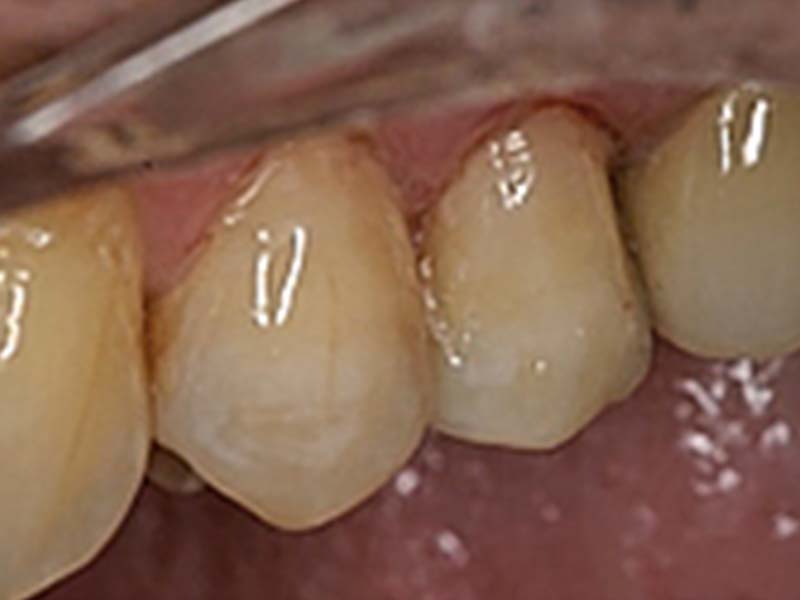 clinical-procedure-embrace-class-v-7