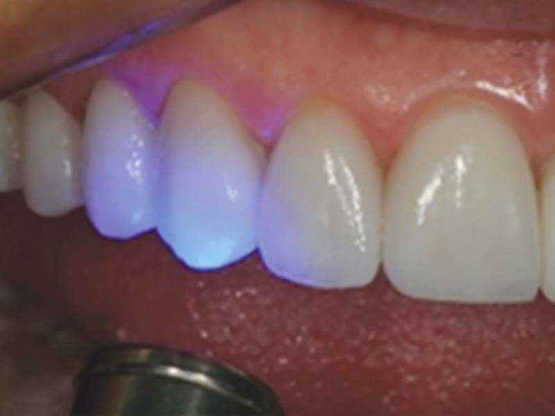 clinical-procedure1-kleer-veneer-4