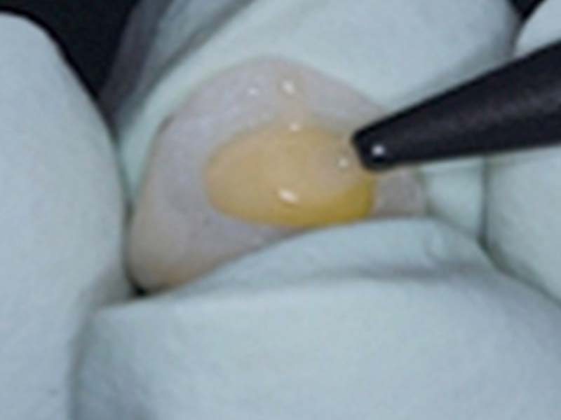 clinical-procedure2-embrace-ciment-2