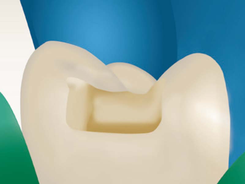 clinical-procedure-activa-presto-1