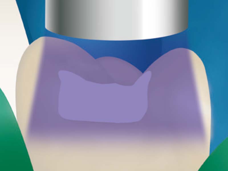 clinical-procedure-activa-presto-5