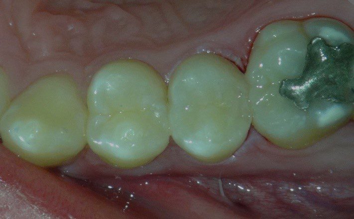 Lesen Sie mehr über den Artikel Direkt aus dem Operationssaal: Minimalinvasive bioaktive Versorgungen