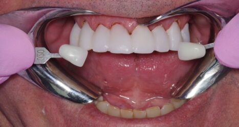 Neues eBook: Wie Sie langlebige und ästhetische Provisorien herstellen