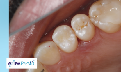 NEUES VIDEO! Dr. Joshua Austin x Dental Economics präsentieren ACTIVA Presto