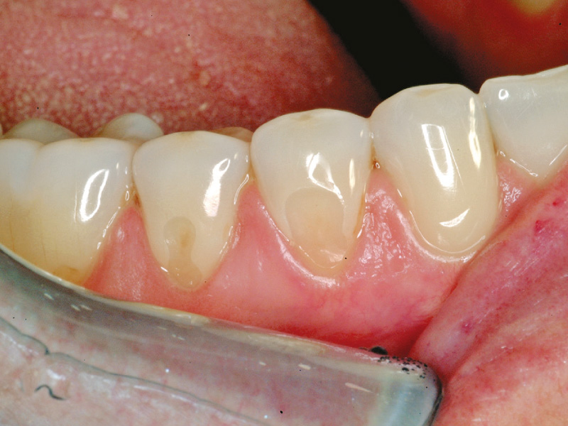 cervical-lesion-procedure-2024-1