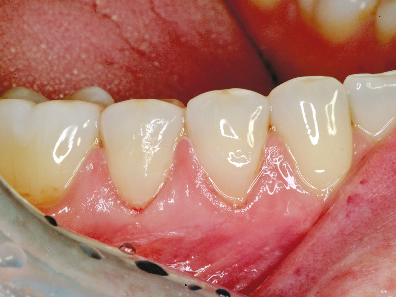 cervical-lesion-procedure-2024-2