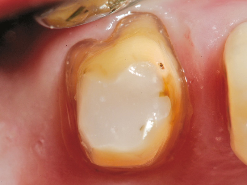 core-build-up-procedure-2024-2