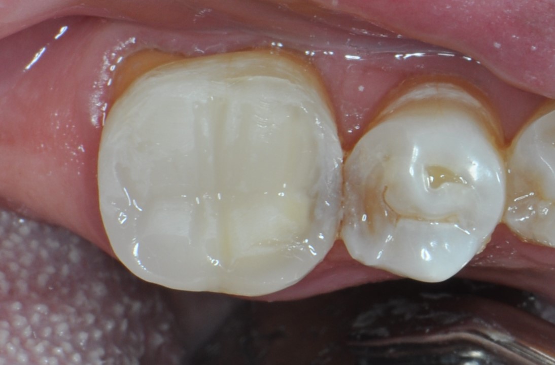 Final restoration