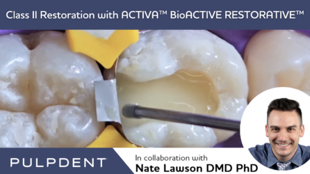 Klasse II Restauration mit ACTIVA™ BioACTIVE-RESTORATIVE™