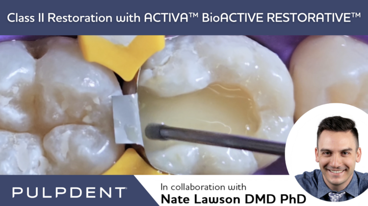 Lesen Sie mehr über den Artikel Klasse II Restauration mit ACTIVA™ BioACTIVE-RESTORATIVE™