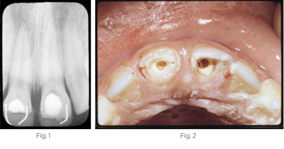 Dentin-Bridge_Case2-v2