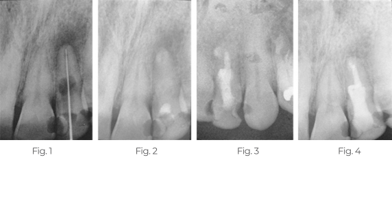 Periapical-Lesion1234-v2