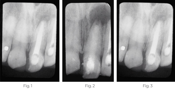Persistent-Periapical-Lesion1234-v2